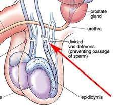 Understanding Vasectomy Procedures: A Comprehensive Guide